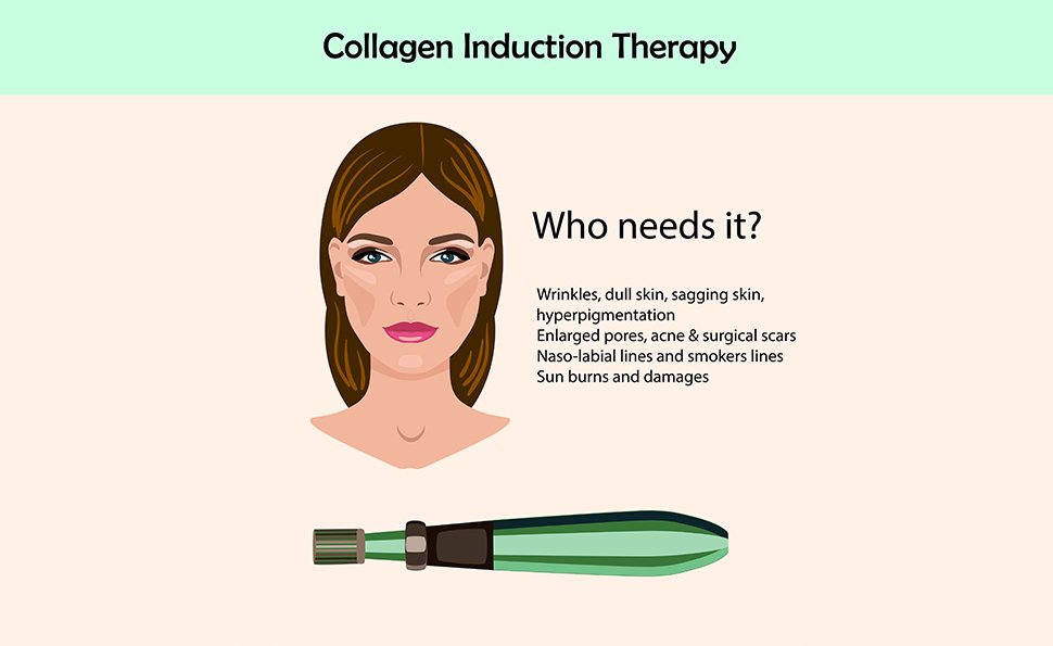 Collagen Induction therapy
