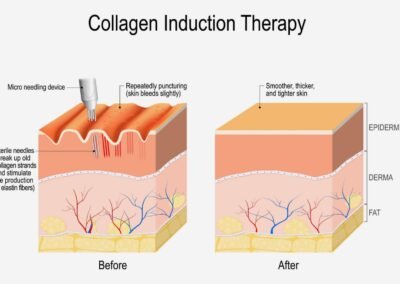 Collagen-induction-therapy